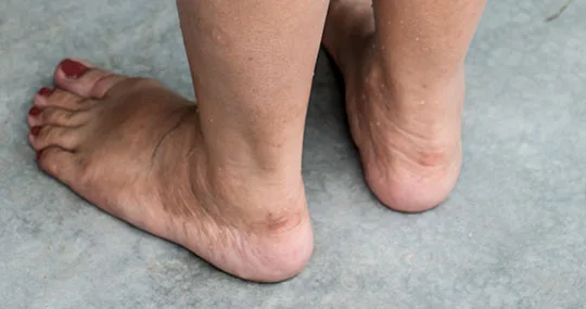 Factores de riesgo que causan dismetría en las piernas
