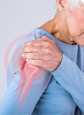 Bursitis de hombro