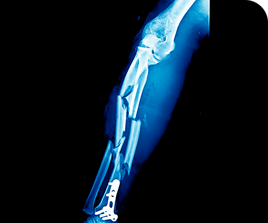 Fracturas conminutas - síntomas de una fractura